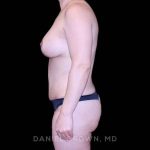 Mommy Makeover Before & After Patient #10441