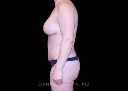 Mommy Makeover Before & After Patient #10441