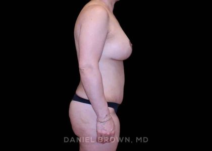 Mommy Makeover Before & After Patient #10441