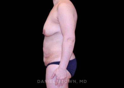 Mommy Makeover Before & After Patient #10441