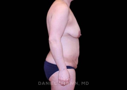 Mommy Makeover Before & After Patient #10441