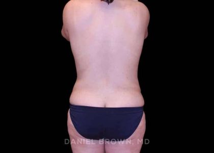 Mommy Makeover Before & After Patient #10441