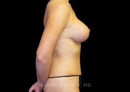Mommy Makeover Before & After Patient #10452
