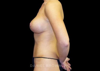 Mommy Makeover Before & After Patient #10452