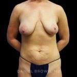 Mommy Makeover Before & After Patient #10452