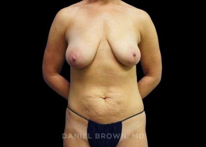 Mommy Makeover Before & After Patient #10452