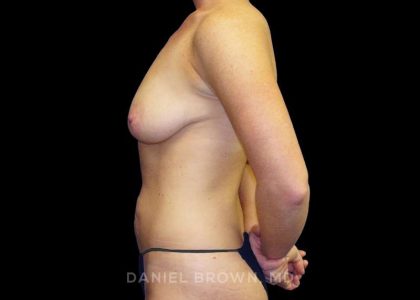 Mommy Makeover Before & After Patient #10452
