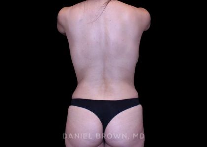 Tummy Tuck Before & After Patient #10946