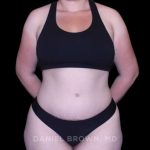 Tummy Tuck Before & After Patient #10977