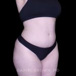 Tummy Tuck Before & After Patient #10977