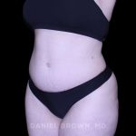 Tummy Tuck Before & After Patient #10977