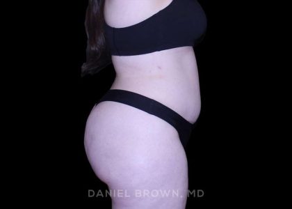 Tummy Tuck Before & After Patient #10977