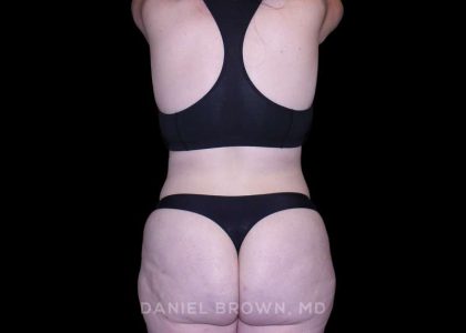 Tummy Tuck Before & After Patient #10977