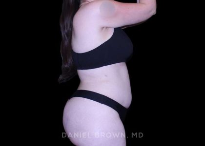 Tummy Tuck Before & After Patient #10977