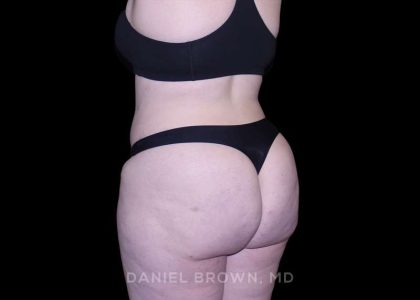 Tummy Tuck Before & After Patient #10977