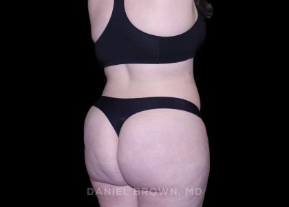 Tummy Tuck Before & After Patient #10977