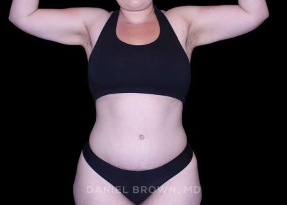 Tummy Tuck Before & After Patient #10977