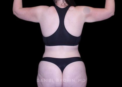 Tummy Tuck Before & After Patient #10977