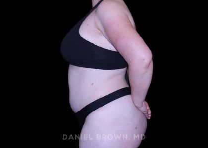 Tummy Tuck Before & After Patient #10977