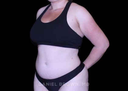 Tummy Tuck Before & After Patient #10977