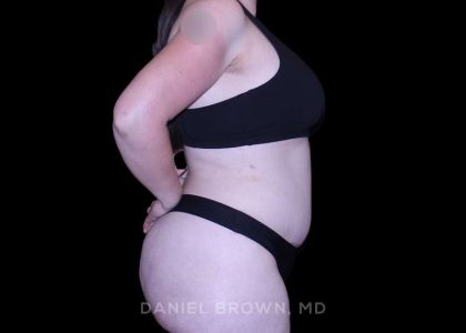 Tummy Tuck Before & After Patient #10977