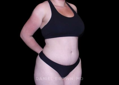 Tummy Tuck Before & After Patient #10977