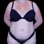 Tummy Tuck Before & After Patient #10977