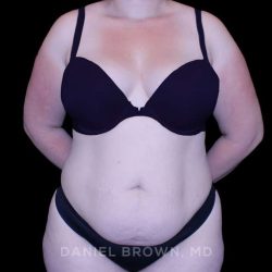 Tummy Tuck Before & After Patient #10977
