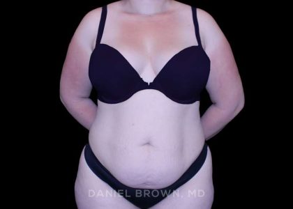 Tummy Tuck Before & After Patient #10977