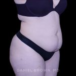 Tummy Tuck Before & After Patient #10977