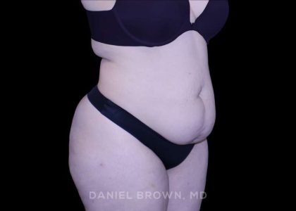 Tummy Tuck Before & After Patient #10977