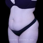 Tummy Tuck Before & After Patient #10977