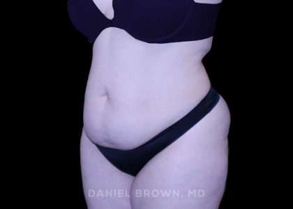 Tummy Tuck Before & After Patient #10977