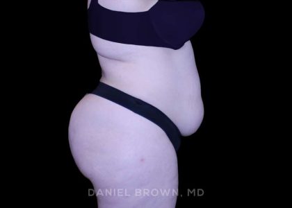 Tummy Tuck Before & After Patient #10977