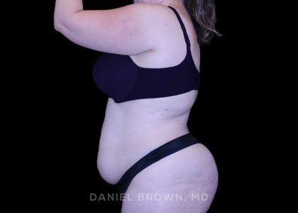 Tummy Tuck Before & After Patient #10977