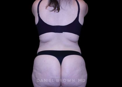 Tummy Tuck Before & After Patient #10977