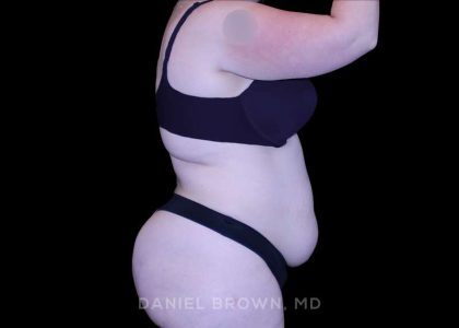 Tummy Tuck Before & After Patient #10977