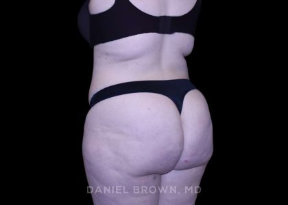 Tummy Tuck Before & After Patient #10977