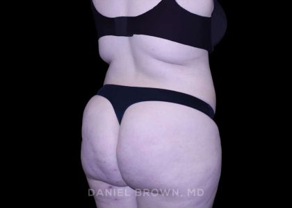 Tummy Tuck Before & After Patient #10977