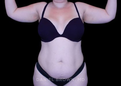 Tummy Tuck Before & After Patient #10977