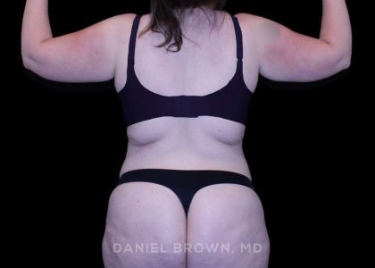 Tummy Tuck Before & After Patient #10977