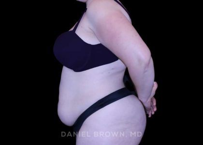 Tummy Tuck Before & After Patient #10977