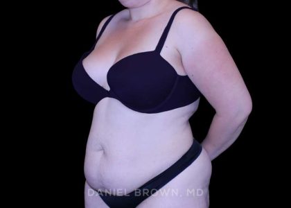 Tummy Tuck Before & After Patient #10977