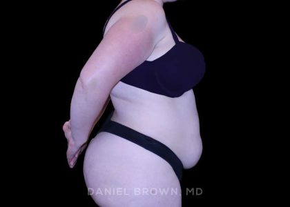 Tummy Tuck Before & After Patient #10977