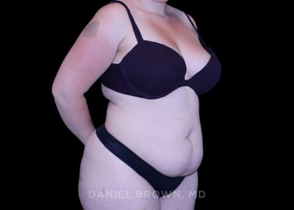 Tummy Tuck Before & After Patient #10977
