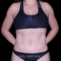 Tummy Tuck Before & After Patient #11000