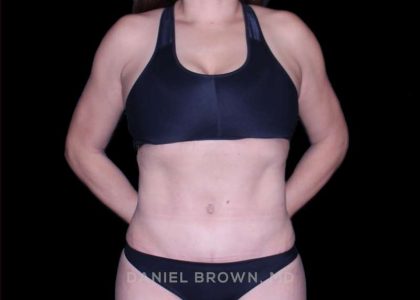 Tummy Tuck Before & After Patient #11000