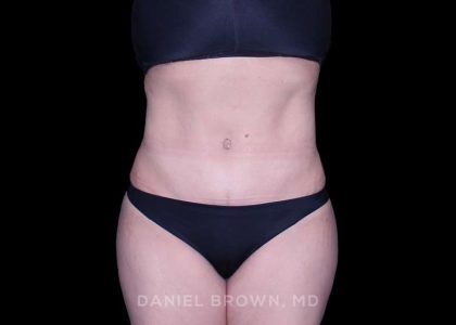 Tummy Tuck Before & After Patient #11000