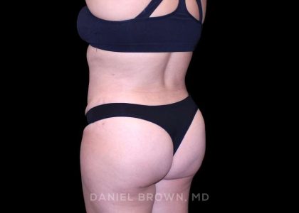 Tummy Tuck Before & After Patient #11000