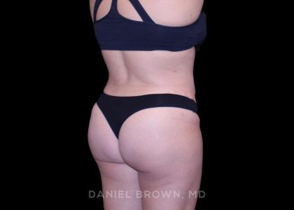 Tummy Tuck Before & After Patient #11000